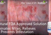 What Kills Scabies On Furniture