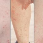 Can Scabies Live On Furniture