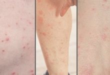 Can Scabies Live On Furniture